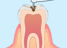 虫歯治療1